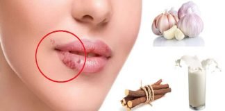 10 Remedios Caseros Para Curar o Al Menos Calmar Los Fuegos Labiales (Herpes Labial)