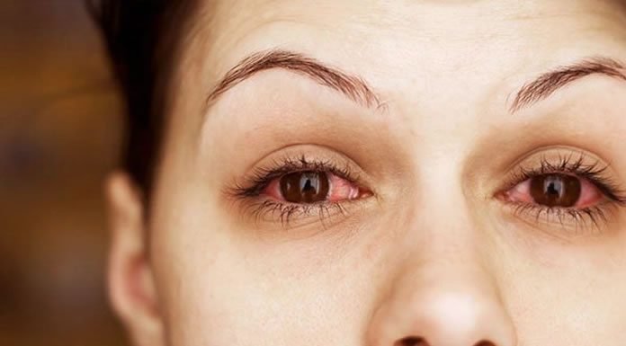 Cómo Puedes Darte Cuenta De Que Te Estás Enfermando De Conjuntivitis