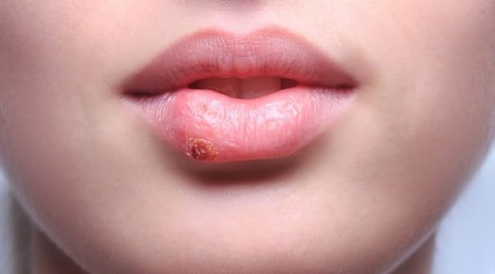 Mitos Y Realidades Sobre Los Diferentes Tipos De Herpes